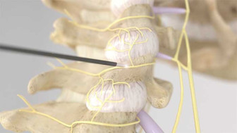 Radio Frequency Nerve Ablation Procedure (Rhizotomy) Cervical Spine