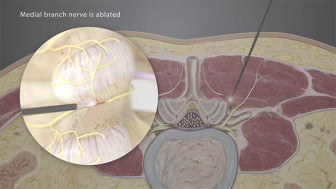 Radio Frequency Nerve Ablation Procedure (Rhizotomy) Lumbar Spine