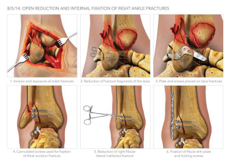 Right Ankle ORIF