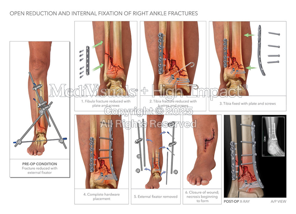 $2.4M Verdict: Illustrating Ankle Fractures After Drunk Driving Crash