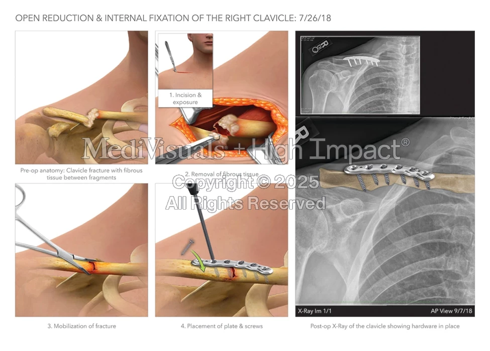 $1M Settlement: Illustrating Fractured Jaw After Cyclist Hit by Truck