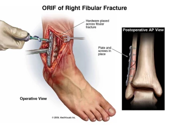 ORIF of Right Fibular Fracture