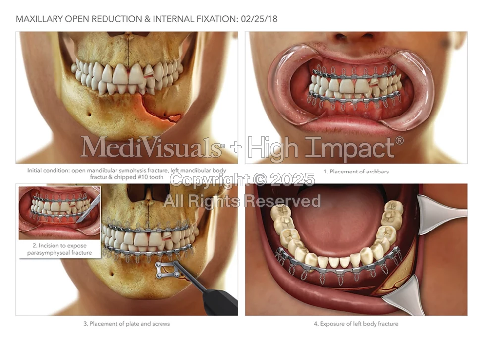 $1M Settlement: Illustrating Fractured Jaw After Cyclist Hit by Truck