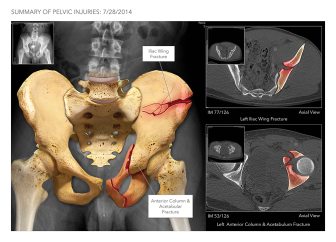Pelvic Injuries & Fixation