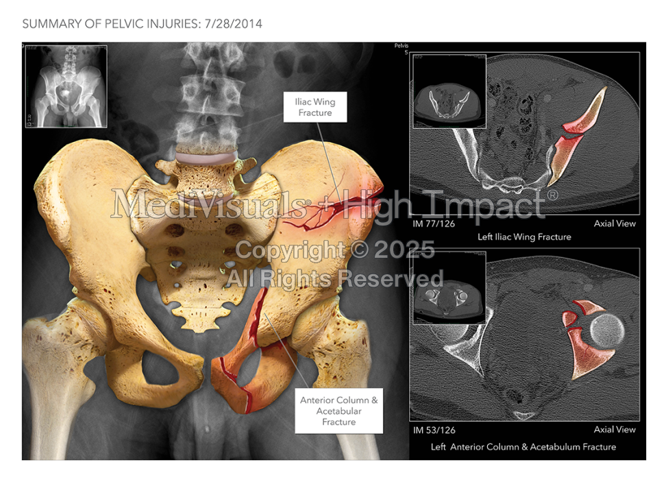 Pelvic Injuries & Fixation