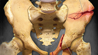 $1.75M Verdict: Colorized Films Highlight Motorcycle Injuries