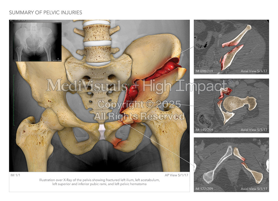 Summary of Pelvic Injuries
