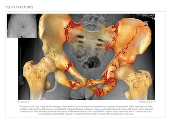 Pelvis Fractures