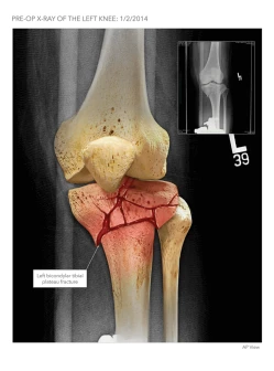 Tibial Plateau Fracture