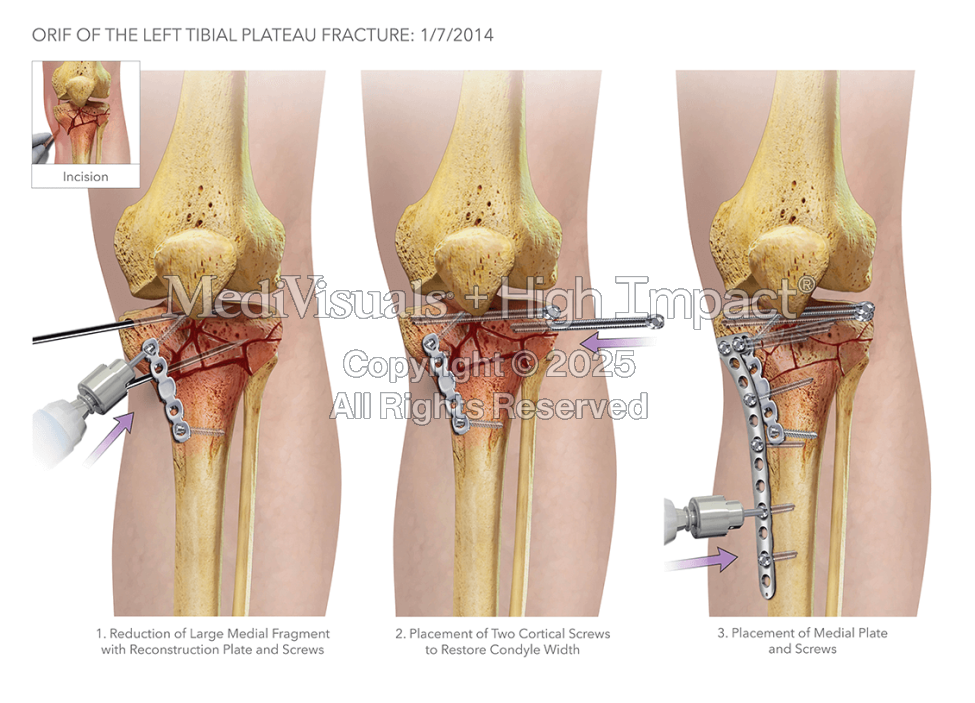 Open Reduction Internal Fixation of the Tibial Plateau Fracture