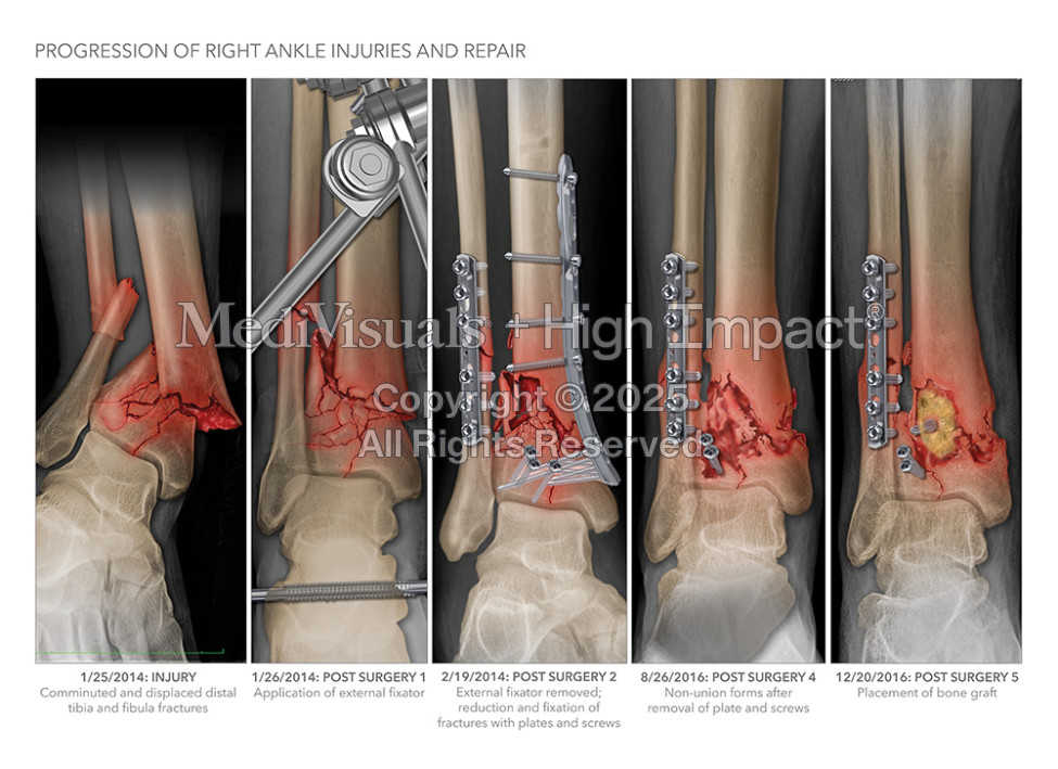 $2.4M Verdict: Illustrating Ankle Fractures After Drunk Driving Crash