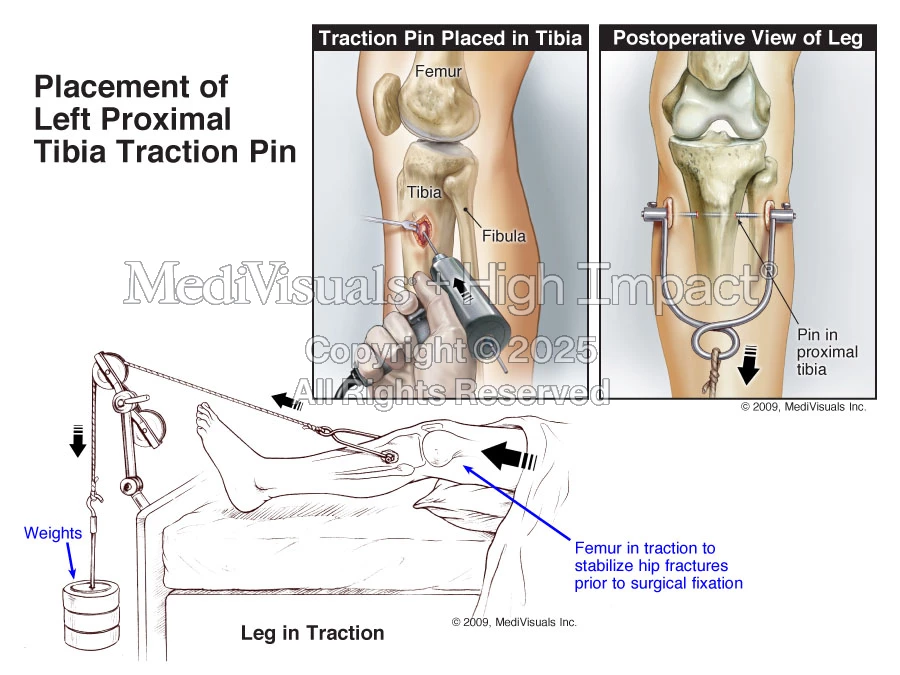Left Tibia Fixation Placement of Left Proximal Tibia Traction Pin