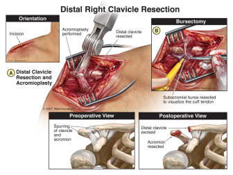 Open Distal Right Clavicle Resection