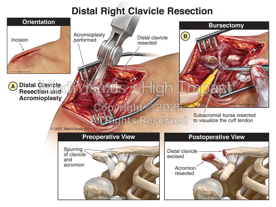 Open Distal Right Clavicle Resection