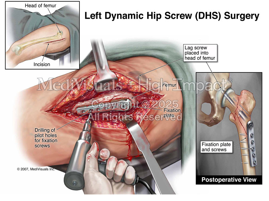 Left Dynamic Hip Screw (DHS) Surgery