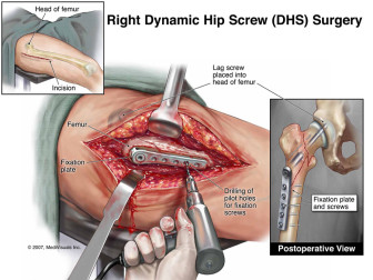 Right Dynamic Hip Screw (DHS) Surgery