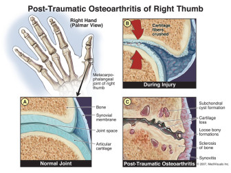 Post-Traumatic Osteoarthritis of Right Thumb