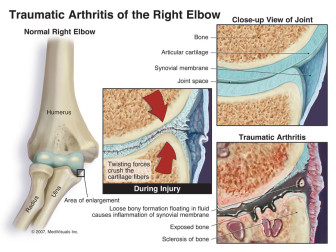 Traumatic Arthritis of the Right Elbow