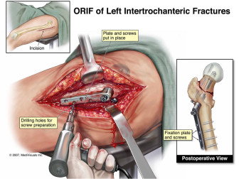 ORIF of Left Hip Fracture