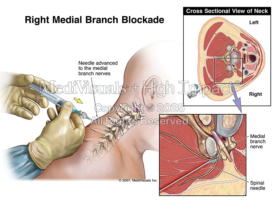 Right Medial Branch Blockade