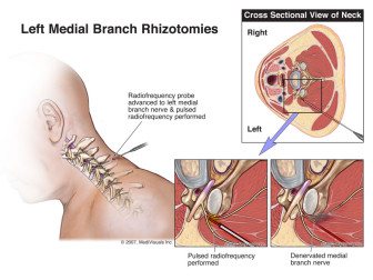 Left Medial Branch Rhizotomies (Radiofrequency Ablation)