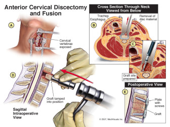 Discectomy and Fusion
