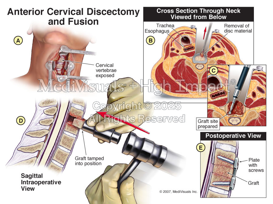 Discectomy and Fusion