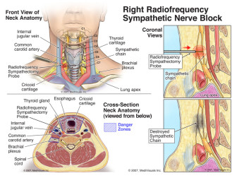 Right Radiofrequency Sympathetic Nerve Block (Radiofrequency Ablation)