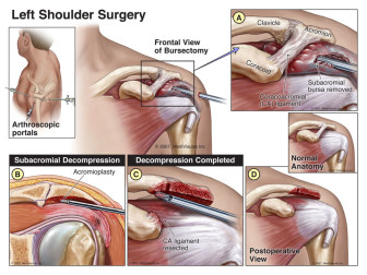 Left Shoulder Surgery
