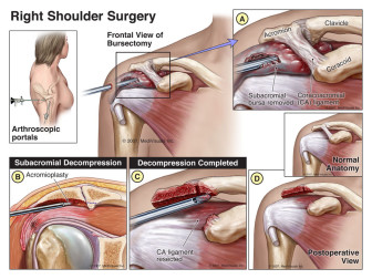 Right Shoulder Surgery