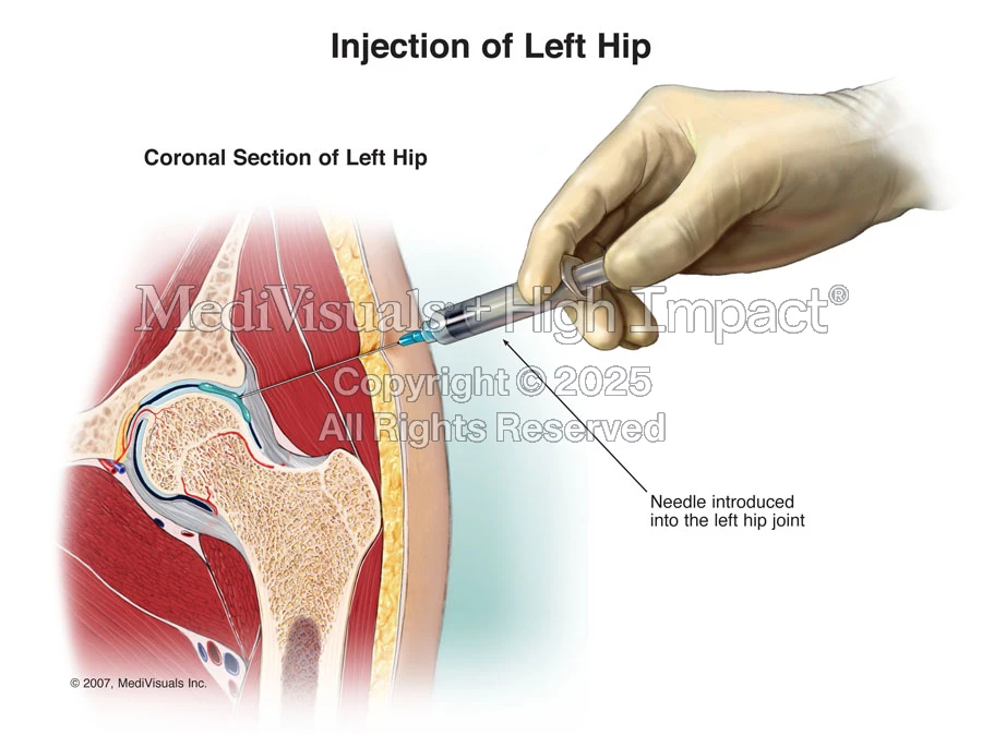 Hip Injection Approach Injection of Left Hip