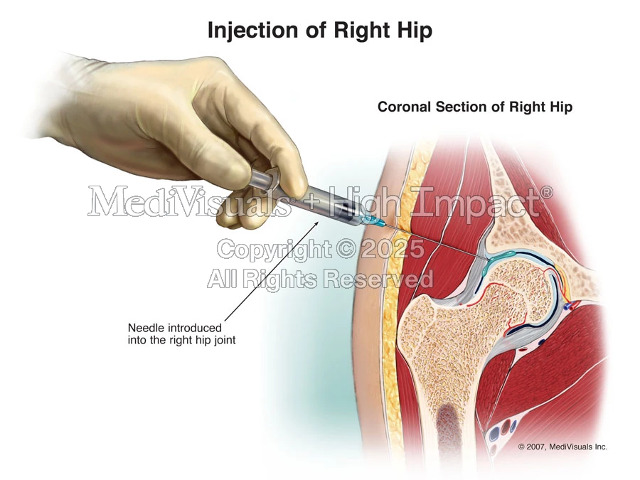 Hip Injection Approach Injection of Right Hip