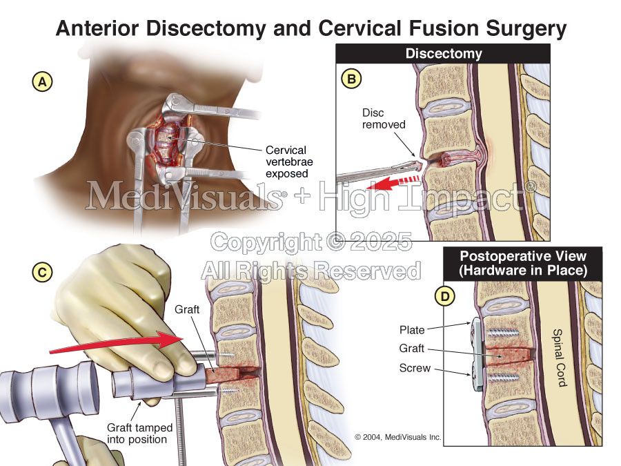 Anterior Discectomy and Cervical  Fusion Surgery