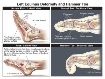 Left Equinus Deformity and Hammer Toe