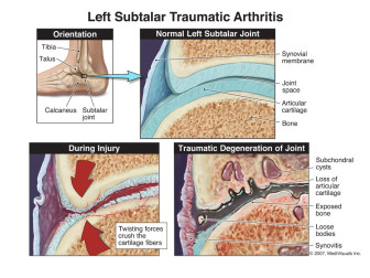 Left Ankle Traumatic Arthritis
