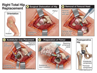 Right Total Hip Replacement (Arthroplasty)
