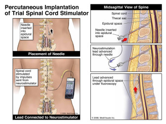 Percutaneous Implantation of Trial Spinal Cord Stimulator