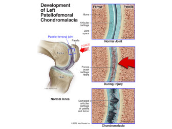 Development of Patellofemoral Chondromalacia (Post-traumatic arthritis)