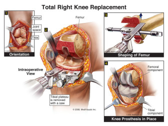 Total Right Knee Replacement (Arthroplasty)