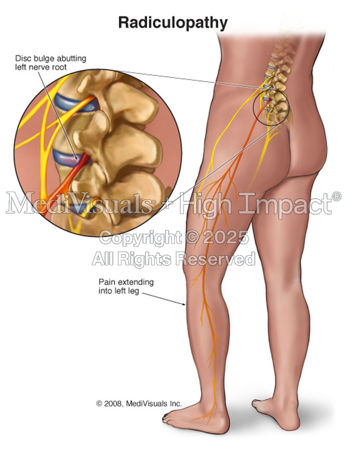 Lumbar Radiculopathy