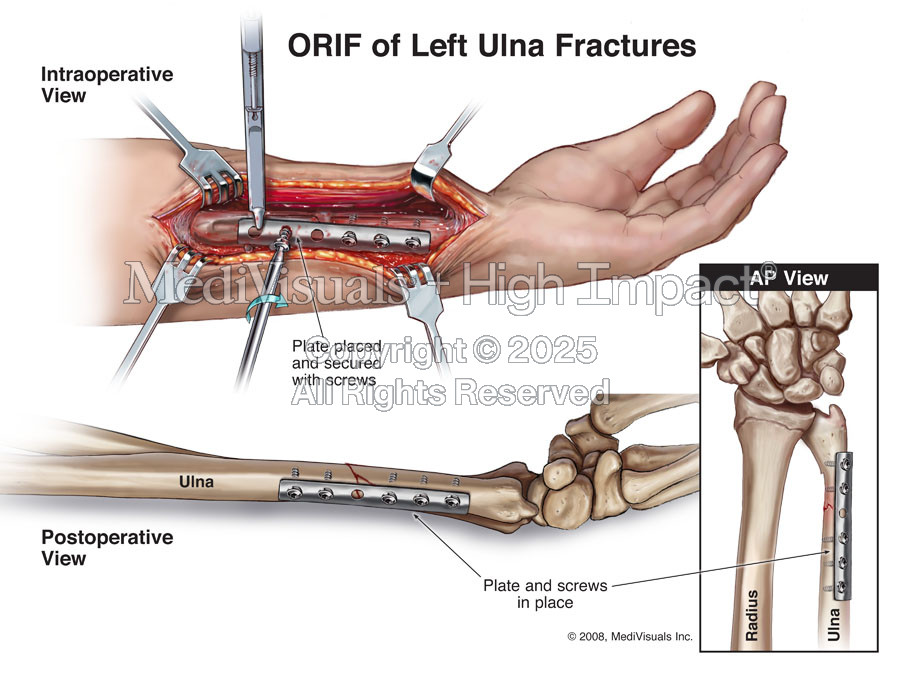 ORIF of Left Ulna Fractures