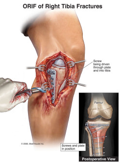 ORIF of Right Tibia Fractures