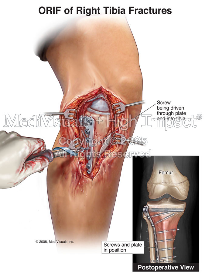 ORIF of Right Tibia Fractures