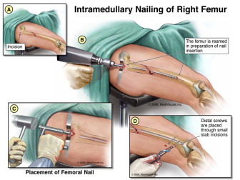Intramedullary Nailing (Rodding) of Right Femur (Antegrade)