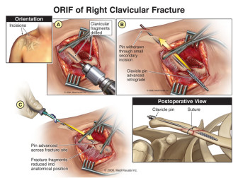 ORIF of Right Clavicular Fracture