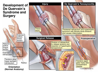 Development of De Quervain’s Syndrome and Surgery