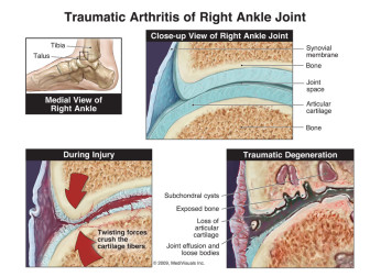 Traumatic Degeneration of Right Ankle Joint (Post-traumatic Arthritis)