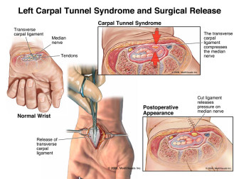 Left Carpal Tunnel Syndrome and Surgical Release