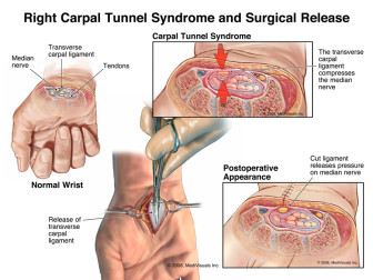Right Carpal Tunnel Syndrome and Surgical Release