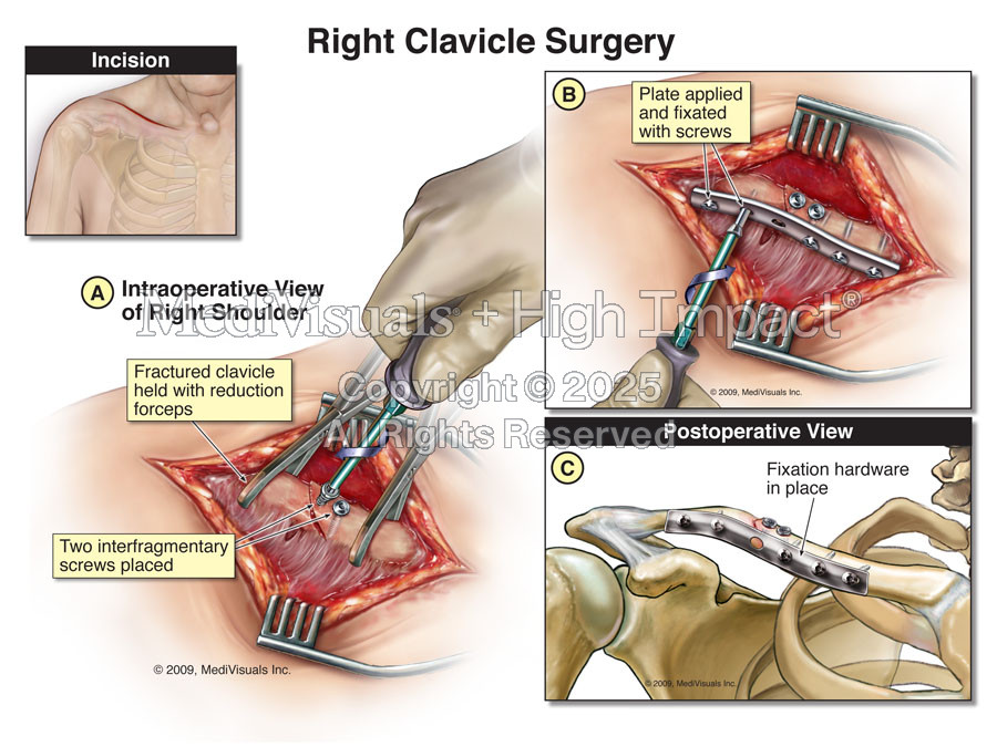 Right Clavicle Surgery (ORIF of Clavicle Fracture)